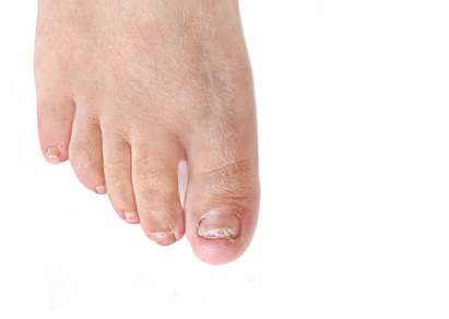 Toenail fungus infection – dermatophytic onychomycosis