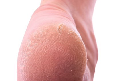 Closeup of a person with dry skin on heel . Isolated on white background. With clipping path inckuded.